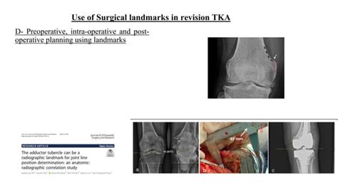 Surgical Landmarks In Revision Total Knee Ppt