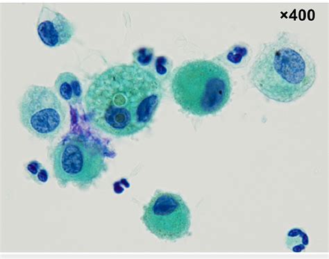 Cytological Examination Of The Bronchoalveolar Lavage Fluid Balf