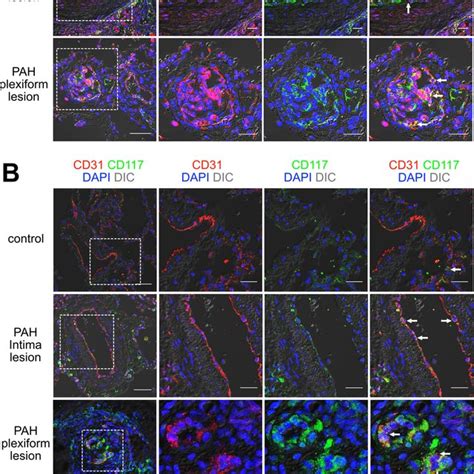 Localization Of Cd117⁺ Ecs In Pah And Control Pulmonary Arteries A B Download Scientific