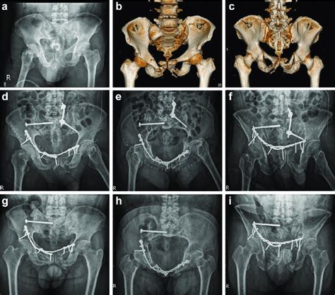 A 62-year-old male with anterior and posterior pelvic ring injury. a... | Download Scientific ...