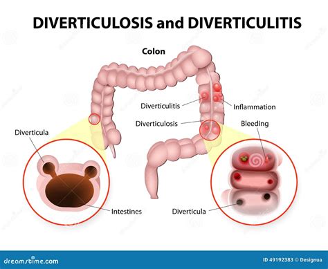 Diverticulosis And Diverticulitis Stock Vector Illustration Of