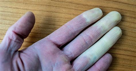 sindrom raynaud ketahui daftar penyebab   gejalanya