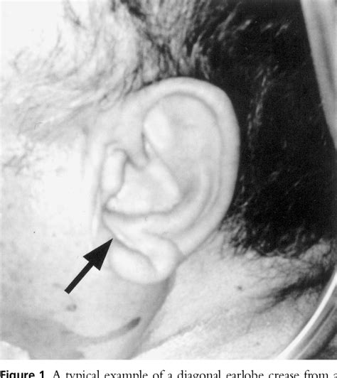 Figure 1 From Evaluation Of Diagonal Earlobe Crease As A Marker Of