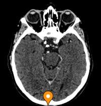 Occiput - e-Anatomy - IMAIOS