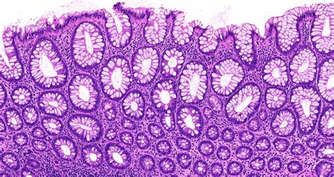 Hyperplastic Polyp Gross