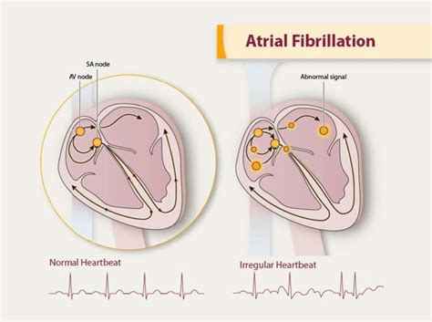 Atrial Fibrillation Awareness Month Sacred Journey Hospice