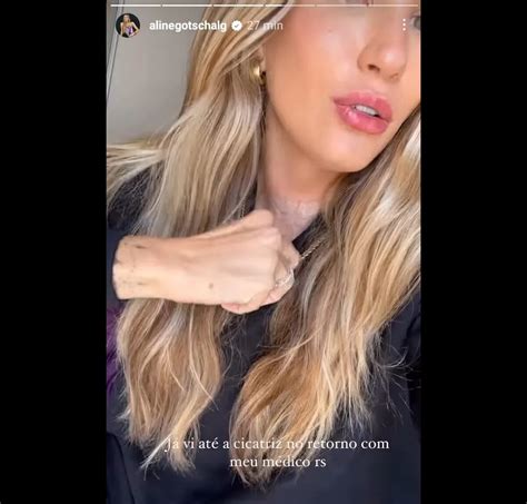 Foto Para Os Seguidores Aline Gotschalg Mostou Cicatriz Da Cirurgia