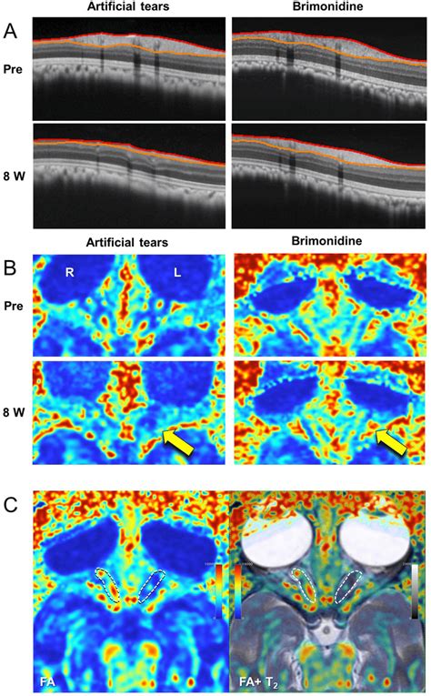 Representative Spectral Domain Optical Coherence Tomography Sd Oct