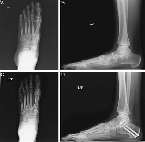 A D Preoperative And Postoperative Weight Bearing Radiographs Of Type