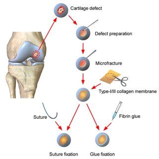 PDF Autologous Matrix Induced Chondrogenesis A Systematic Review Of