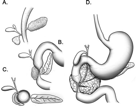 Congenital Duodenal Obstruction Atresia Stenosis And Annular