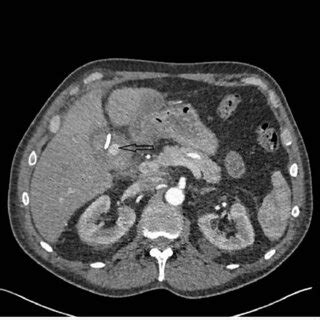 CT Angiogram Showing A Pseudoaneurysm Of The Cystic Artery Within The