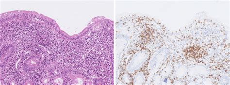 Figure Pathological Findings From The Biopsy Of The Duodenum A