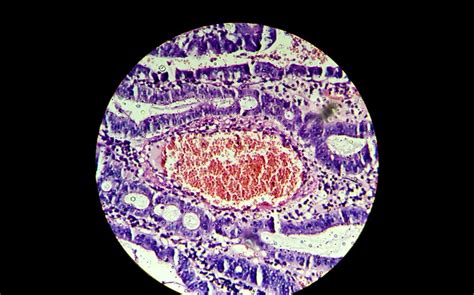 Cáncer Llegan las bacterias capaces de detectar si se está