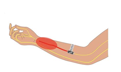 Dissolving Implantable Device Relieves Pain Without Drugs