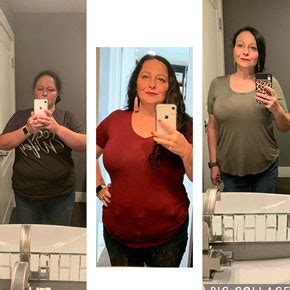 Before And After Gallery Go Light Bariatrics