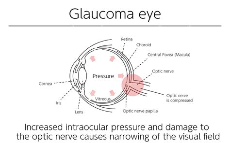 Premium Vector Illustration Glaucoma Of The Eye Medical Illustrations