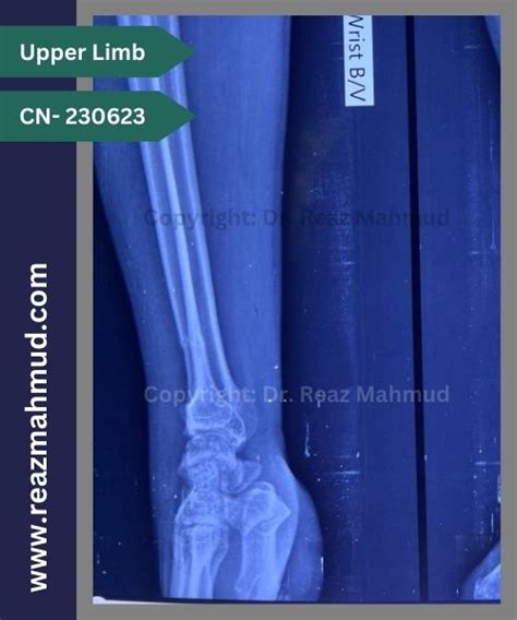 Distal Ulna Fracture ORIF CN 220907 Dr Reaz Mahmud