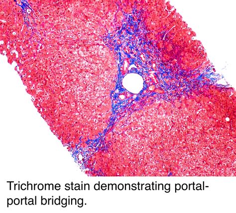 Pathology Outlines Chronic Hepatitis Grading Staging