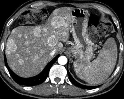 Liver Atlas Diagnosis Metastasis Neuroendocrine Tumor