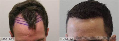 Dr H Rahal Hair Transplant Surgery Before And After Images With 2549