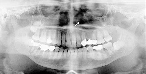 Orthopantomogram Showing A Well Defined Radiopacity In Relation To