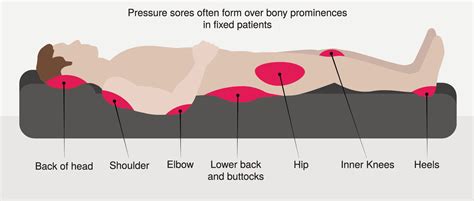 Pressure Injury 101: Stage 1 Pressure Ulcers