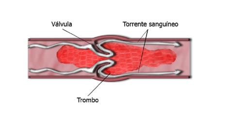 Embolia Cerebral Tipos S Ntomas Secuelas Y Causas