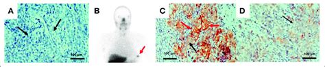 Patient 26. (A) Immunohistochemistry analysis shows very low HER2 ...