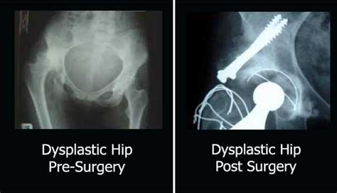 Hip Dysplasia – Mr Khalid Drabu