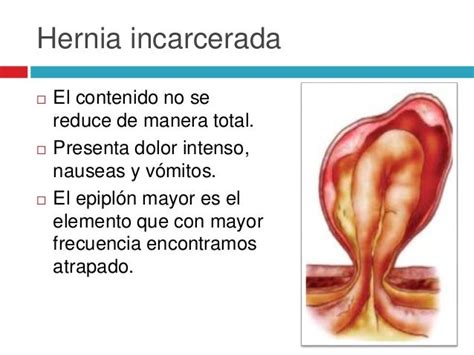 Hernias