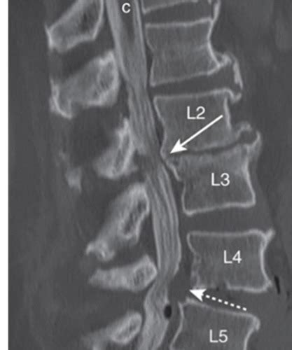 Spine Neuroimaging Flashcards Quizlet