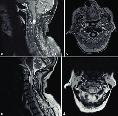 Sagittal A And Axial B T1 Weighted Gadoliniumenhanced Sagittal