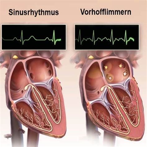 Vorhofflimmern Osypka Herzzentrum München