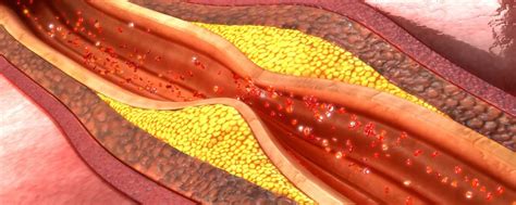 O que você precisa saber sobre Dislipidemia ICcor