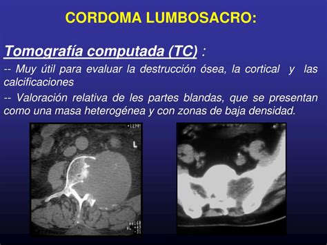 Ppt Cordoma Lumbosacro Diagn Stico Por La Imagen Powerpoint