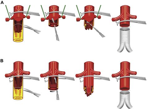 Circumferential Aortic Endarterectomy Followed With Immediate