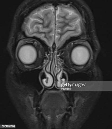 93 Coronal Mri Stock Photos High Res Pictures And Images Getty Images