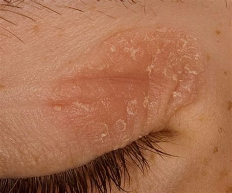 eyelid eczema - pictures, photos