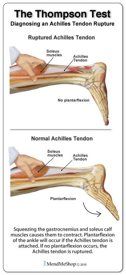 Achilles Tendon Injury Diagnosis Medical Anatomy Physical Therapist