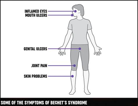 Behçets Syndrome Causes Symptoms Treatments