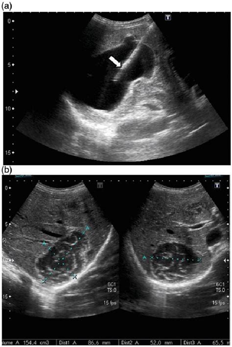 Figure 1 From Percutaneous Treatment Of Liver Hydatid Cysts In 190 Patients A Retrospective