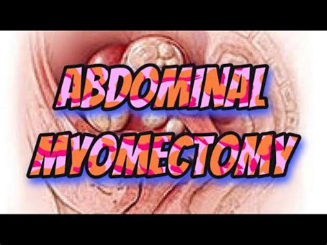 Abdominal Myomectomy Surgery Uterine Fibroids Youtube