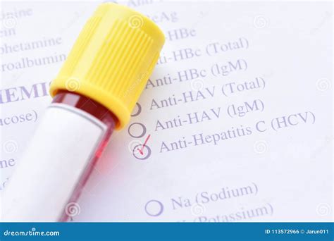 Hepatitis C virus test stock photo. Image of immunology - 113572966