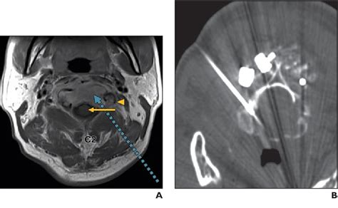 Figure 157 From Percutaneous Intervention Of The C2 Vertebral Body