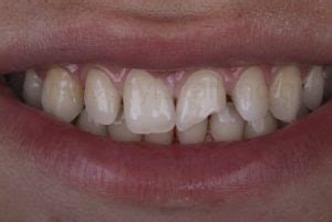 Making Class IV Restorations Predictable