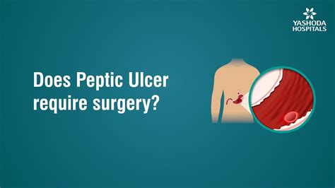 Does Peptic Ulcer Require Surgery Youtube