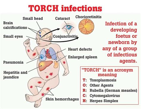 Sindrom Torch Gejala Penyebab Dan Pengobatan