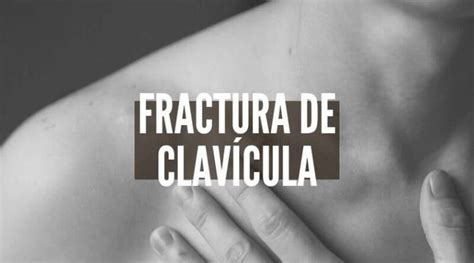 ¿cuánto Tiempo Tarda En Curarse Una Fractura De Clavícula Jl Fisios