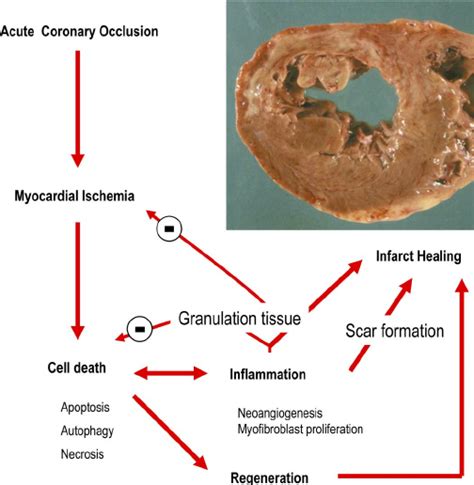 The Complexity Of Events Leading To Infarct Healing After Acute